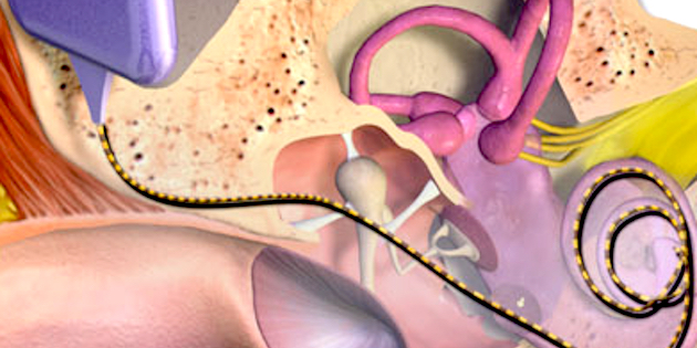 “Highly reliable” scan study shows most cochlear implant recipients develop new bone formation, which adversely affects residual hearing