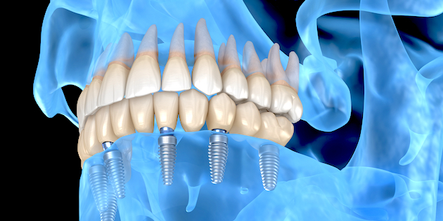 New study increases feasibility of dental implants housing hearing aids