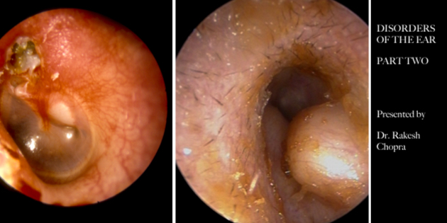 DISORDERS OF THE EAR Pt. 2